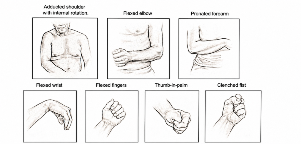 whatisspasticity1